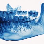 Osteoporosi e odontoiatria, verso uno screening opportunistico con la CBCT osteoporosi