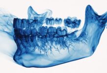 Osteoporosi e odontoiatria, verso uno screening opportunistico con la CBCT osteoporosi