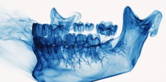 Osteoporosi e odontoiatria, verso uno screening opportunistico con la CBCT osteoporosi