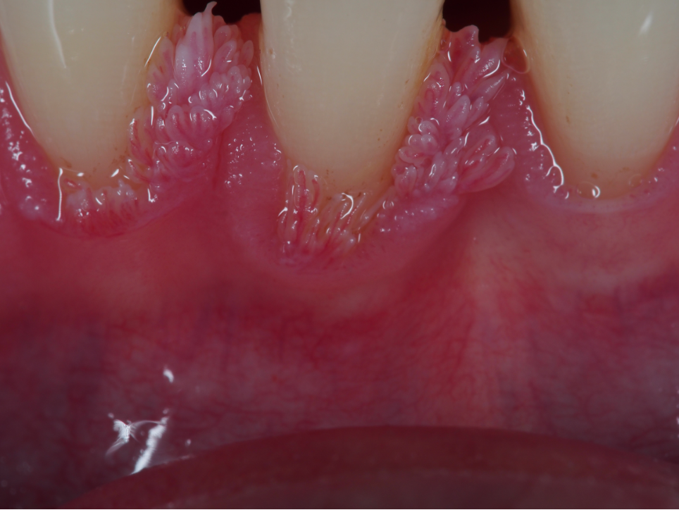 Infezione da HPV