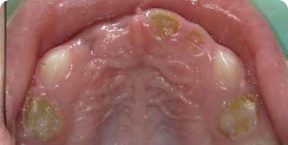 Trattamento delle lesioni cariose nel paziente pediatrico