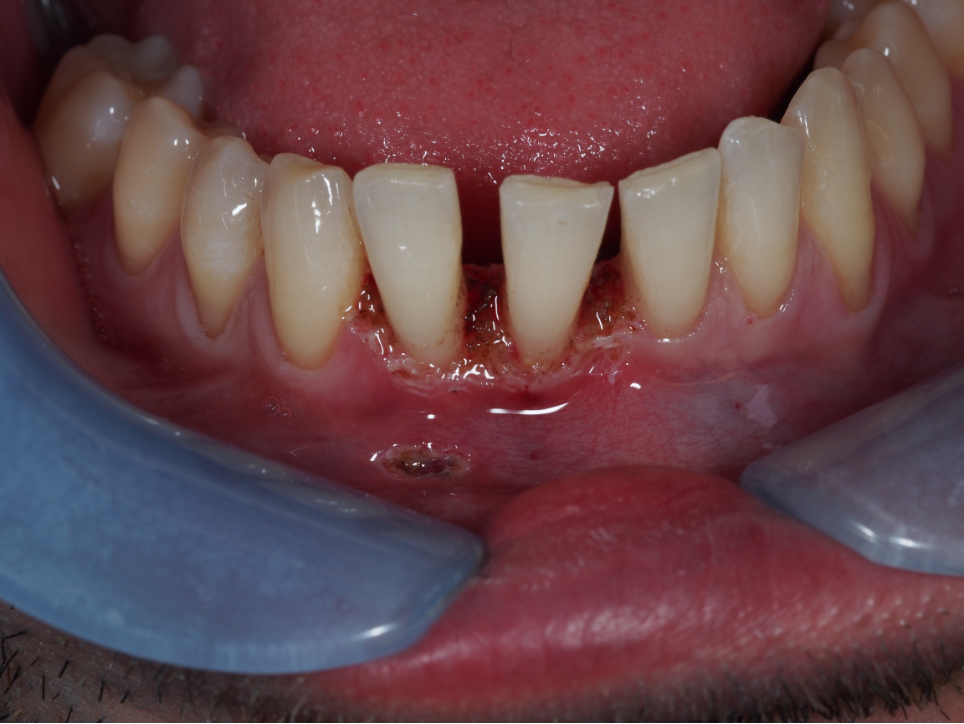 Infezione da HPV