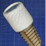 Trattamento della peri-implantite avanzata: prime evidenze su un manicotto di guarigione come scudo fisico e biologico