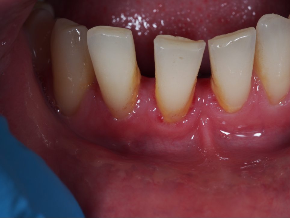 Infezione da HPV