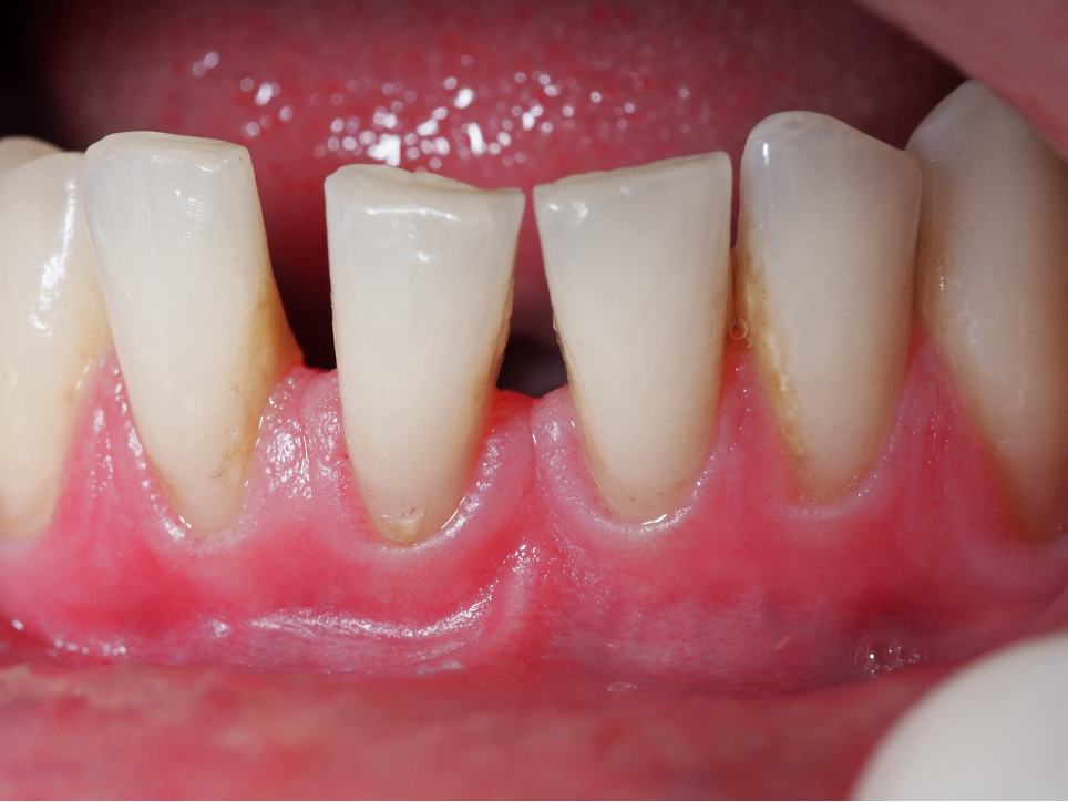 Guarigione da HPV
