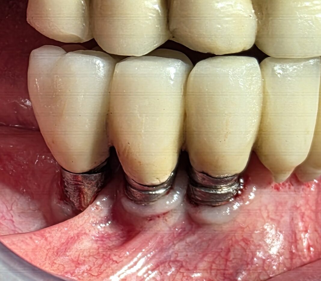 implantoplastica