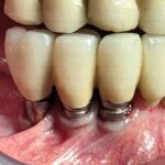 Peri-implantite: revisione della letteratura e linee guida per la terapia