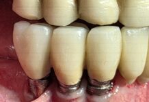 Peri-implantite: revisione della letteratura e linee guida per la terapia