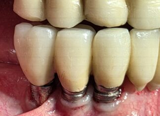 Peri-implantite: revisione della letteratura e linee guida per la terapia