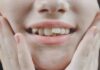 Affollamento dentale: sintomi e trattamenti per migliorare la qualità di vita dei pazienti Affollamento dentale