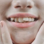 Affollamento dentale: sintomi e trattamenti per migliorare la qualità di vita dei pazienti Affollamento dentale