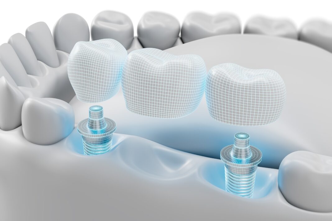 Dental,Implant,Bridge,Structure,With,3d,Modeled,Artificial,Teeth,And stabilità implantare