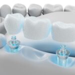 Stabilità implantare: l’ISQ ha davvero valore prognostico? stabilità implantare