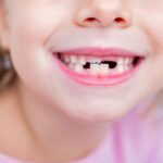 Ipofosfatasia lieve e ortodonzia: uno studio sui rischi per l’osso alveolare Ipofosfatasia