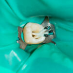 La resistenza alla frattura dei premolari e dei molari trattati endodonticamente resistenza alla frattura dei premolari devitalizzati