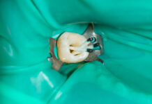 La resistenza alla frattura dei premolari e dei molari trattati endodonticamente resistenza alla frattura dei premolari devitalizzati