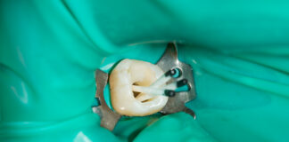 La resistenza alla frattura dei premolari e dei molari trattati endodonticamente resistenza alla frattura dei premolari devitalizzati
