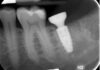 Preservazione alveolare con biomateriale sintetico β-TCP/CS e riabilitazione implantare precoce con protesi avvitata
