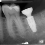 Preservazione alveolare con biomateriale sintetico β-TCP/CS e riabilitazione implantare precoce con protesi avvitata