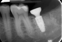 Preservazione alveolare con biomateriale sintetico β-TCP/CS e riabilitazione implantare precoce con protesi avvitata