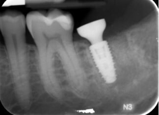 Preservazione alveolare con biomateriale sintetico β-TCP/CS e riabilitazione implantare precoce con protesi avvitata