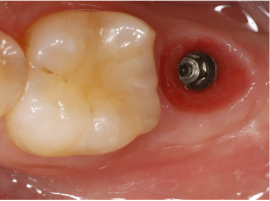 preservazione alveolare