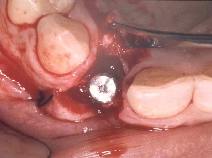 malposizionamento implantare