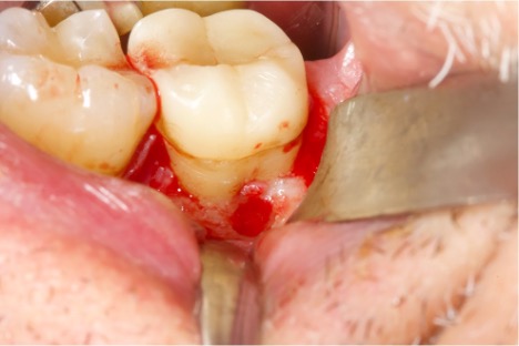 Preservazione alveolare