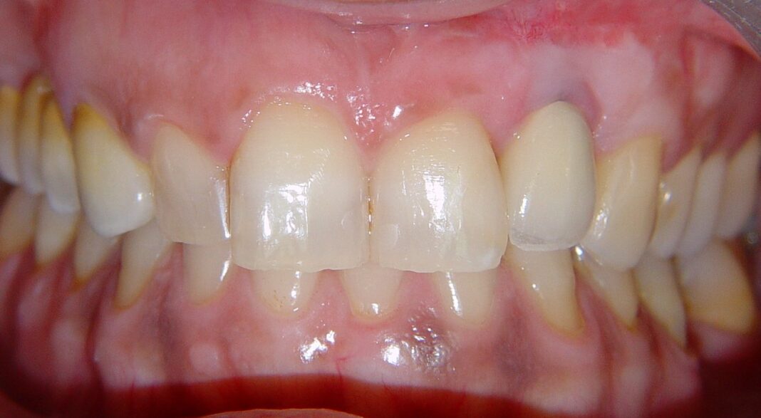 2_Coiana Malposizione implantare