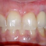 Malposizione implantare, iperplasia mucosa da innesto connettivale e profilo di emergenza protesico in zona estetica Malposizione implantare