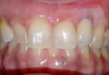 Malposizione implantare, iperplasia mucosa da innesto connettivale e profilo di emergenza protesico in zona estetica Malposizione implantare