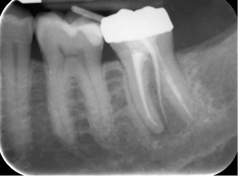 preservazione alveolare