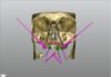Nuovo design in implantologia zigomatica: riabilitazione full-arch mascellare Implantologia zigomatica