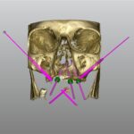 Nuovo design in implantologia zigomatica: riabilitazione full-arch mascellare Implantologia zigomatica