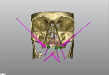 Nuovo design in implantologia zigomatica: riabilitazione full-arch mascellare Implantologia zigomatica