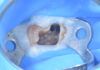 Gestione di un elemento 16 con lesione periapicale associata a missed anatomy lesione periapicale
