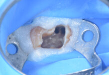 Gestione di un elemento 16 con lesione periapicale associata a missed anatomy lesione periapicale