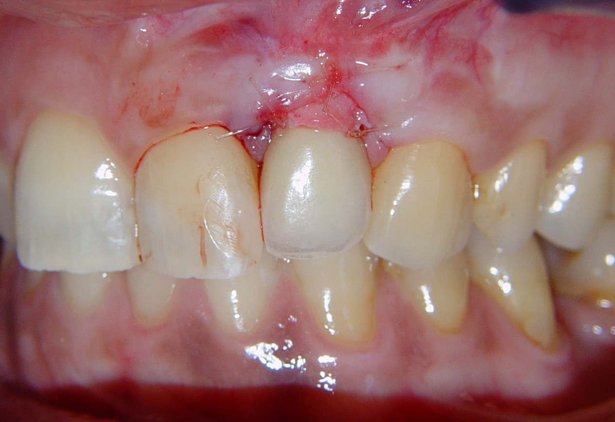 malposizionamento implantare