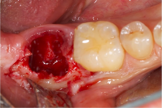 preservazione alveolare