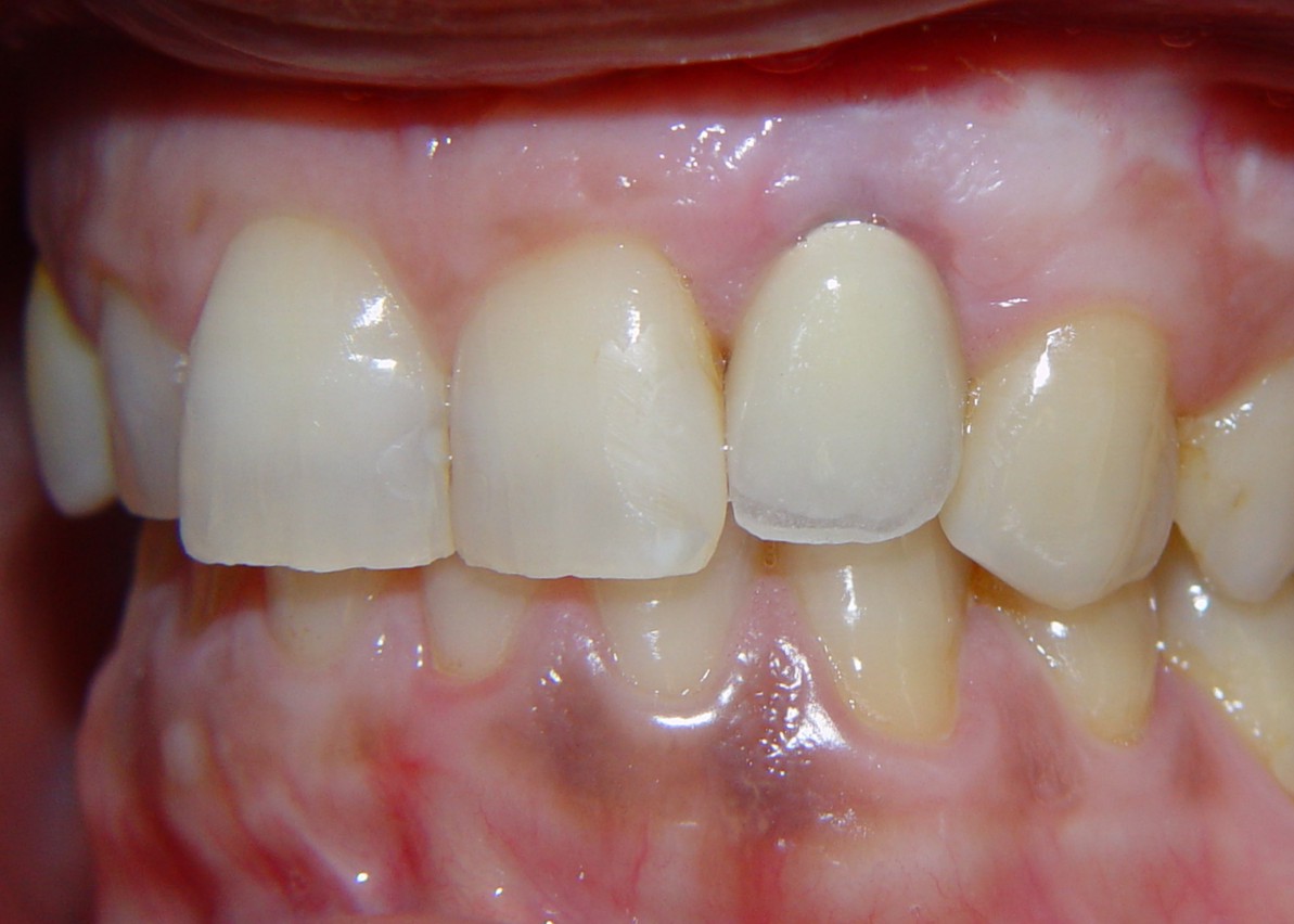 malposizionamwnto implantare
