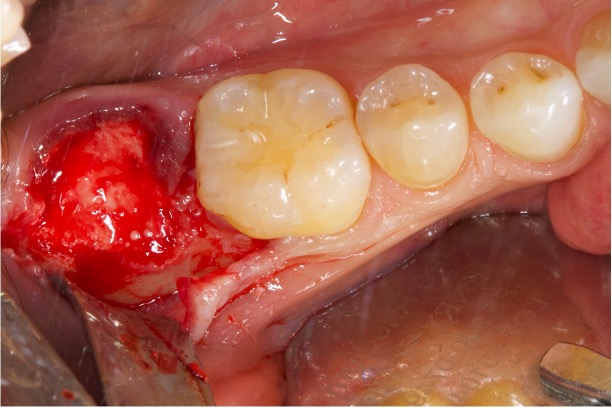 Preservazione alveolare