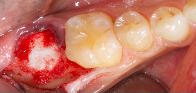 preservazione alveolare