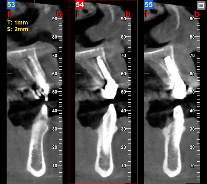 malposizione implantare