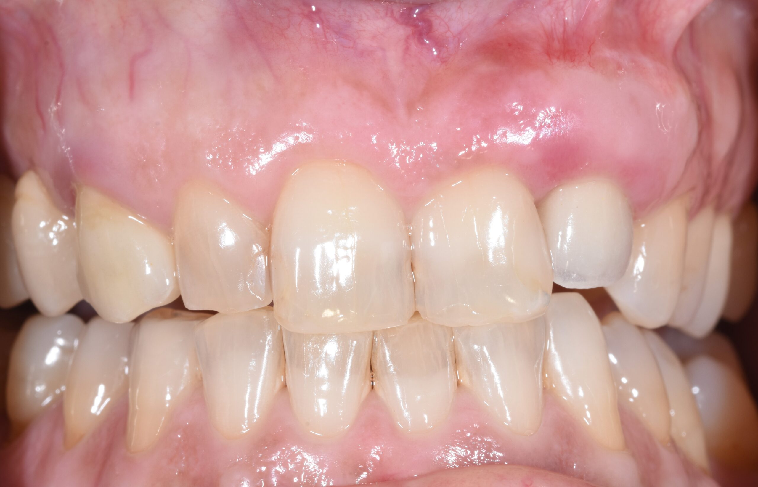 malposizionamento implantare