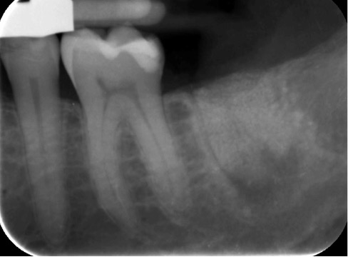 preservazione alveolare