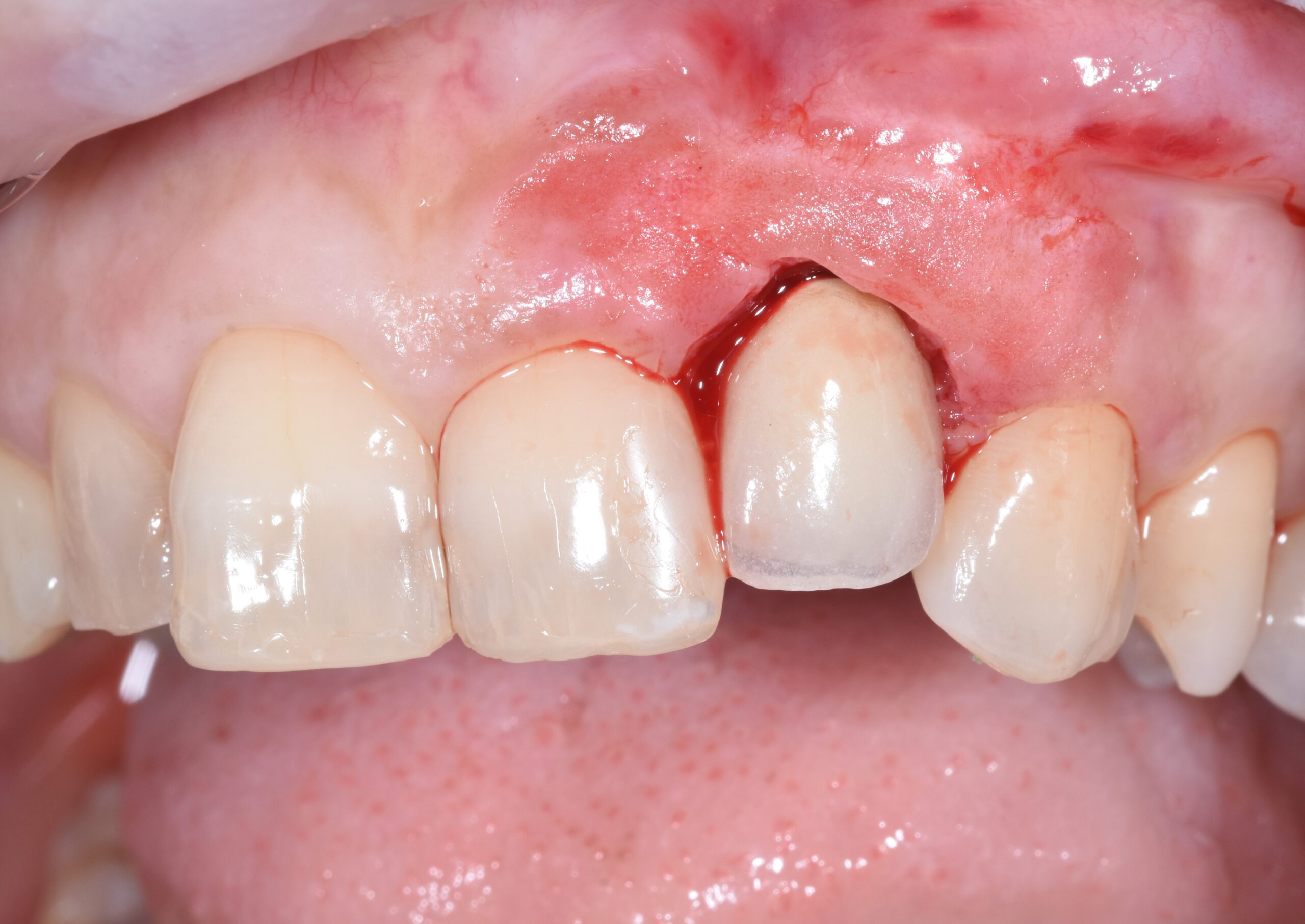 malposizionamento implantare