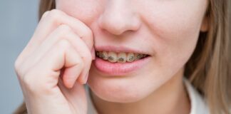 Dolore ortodontico, come trattarlo per migliorare l’esperienza del paziente Dolore ortodontico