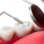 I nuovi compositi BPA-free superano il test di resistenza Nuovi compositi BPA-free