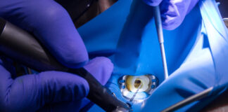 Antibiotici in endodonzia, un nuovo sistema di rilascio Antibiotici