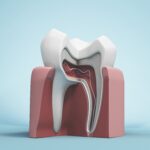 Resezione radicolare, quando è possibile salvare il dente Resezione radicolare